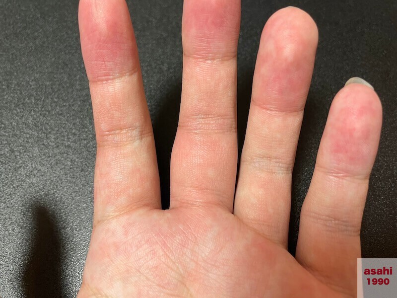 おくとねフィッシングパーク 中指 腫れた